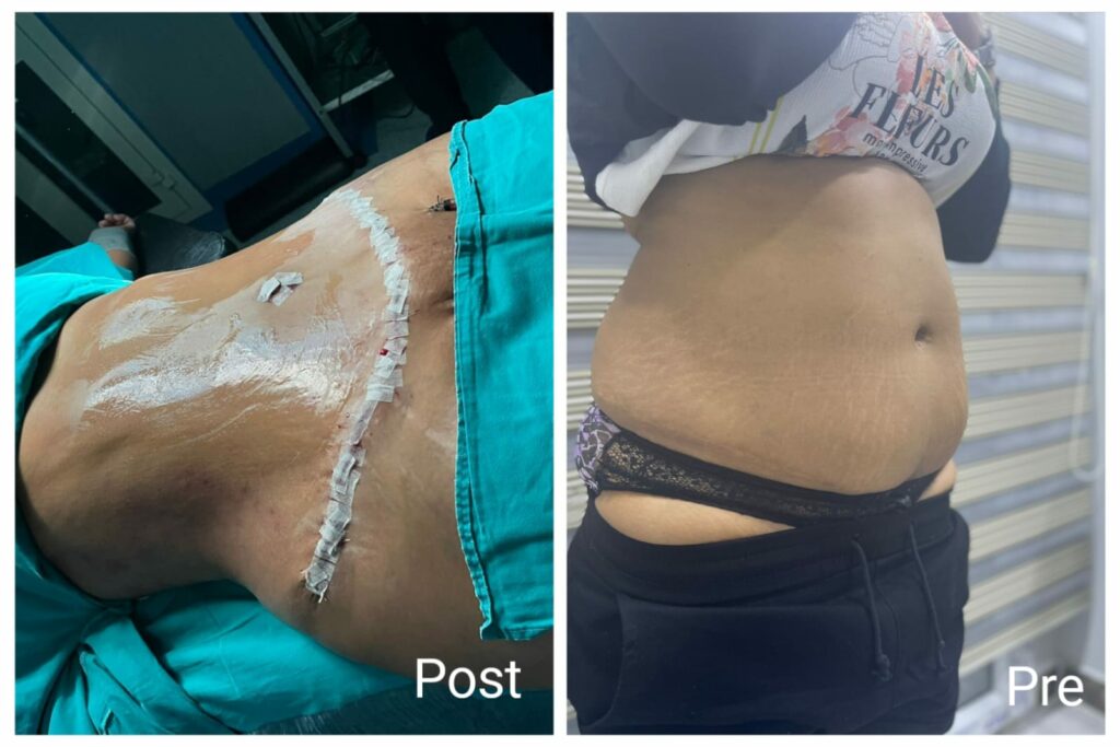 Tummy tuck in Hurghada
